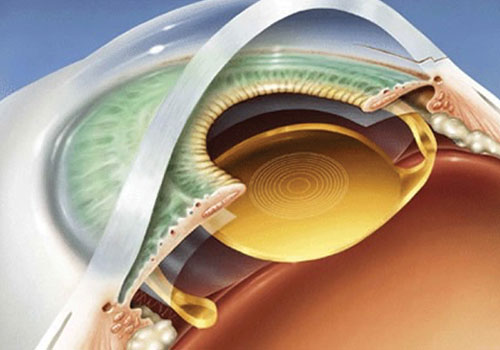 Disegno che illustra una cataratta