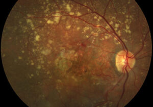 Macro di una degenerazione maculare