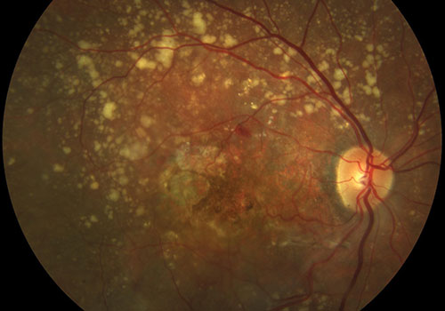 Macro di una degenerazione maculare