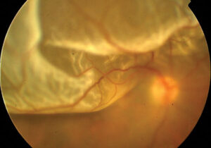 Macro dell'occhio con distacco della retina