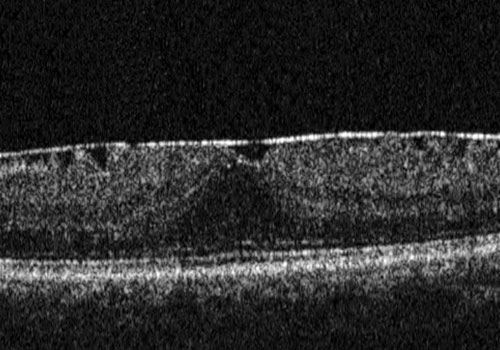membrana_epiretinica2
