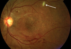 Macro di una retinopatia diabetica