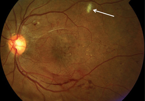 Macro di una retinopatia diabetica