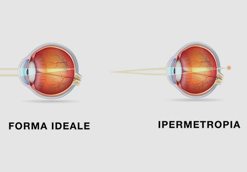 vizi-refrattivi-ipermetropia