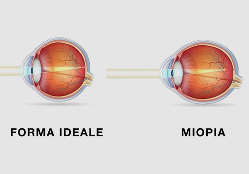 vizi-refrattivi-miopia